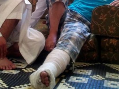 Abu Ali, herido en Alepo, se recupera en su ciudad, Azaz.