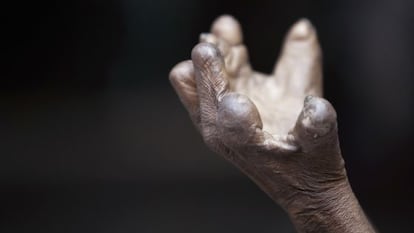La mano de un enfermo de lepra 