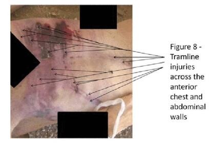 Heridas resultado de los golpes propinados con una barra en el pecho y en el abdomen de un cadáver.