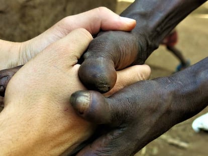 Cuando el bacilo de Hansen ha sido vencido, sigue el sufrimiento, lo peor de la enfermedad, lo más peligroso: el estigma.