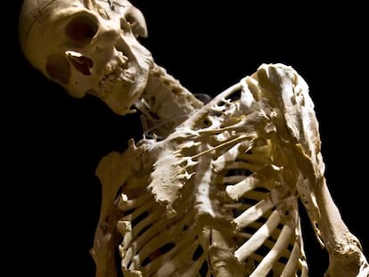 Esqueleto de Harry Eastlack