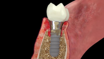 Imagen de una simulación de implante dental en la que se aprecia la acumulación de bacterias sobre la superficie del dispositivo que provoca la inflamación de la encía y la pérdida de hueso alrededor, en una imagen cedida por el periodoncista Antonio Liñares.