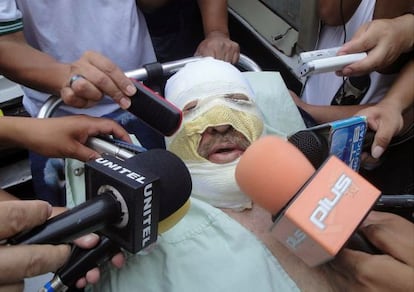 Fernando Vidal talks to reporters after he suffered burns when his radio station was attacked.