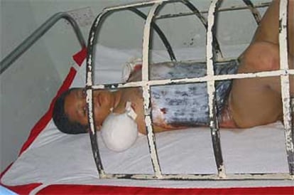 Alí Smain yace en una cama de la unidad de quemados del hospital Kindi, en Bagdad.