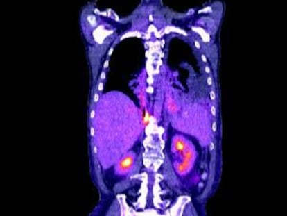 Tomografía de un cáncer de pulmón.