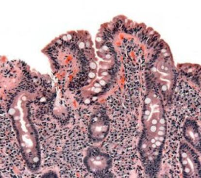La celiaquía destruye las vellosidades intestinales.