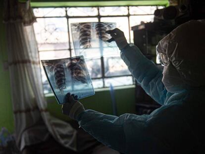 Un médico revisa una placa de rayos X de pulmón mientras visita a un paciente con covid-19 en Comas, en las afueras de Lima, Perú. 