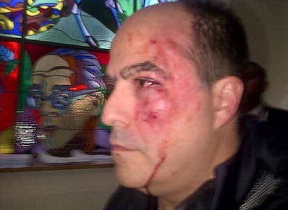 Fotografía cedida por el equipo de prensa del partido político venezolano "Primero Justicia" donde se observa al diputado opositor Julio Borges, ensangrentado, golpeado en un ojo y con el pómulo izquierdo visiblemente hinchado.
