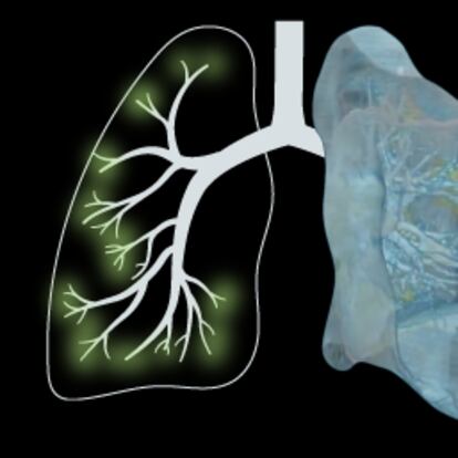 Gráfico promo colapso pulmones