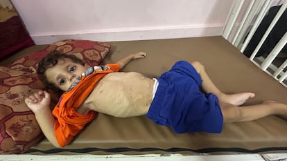 Abdel Rahman Kallab, de dos años, en una imagen tomada el pasado domingo, fue ingresado hace diez días en el hospital Nasser después de que su peso se desplomara en un mes.