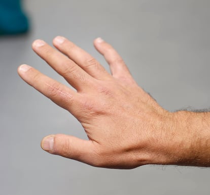 La mano de Gonzalo Santamaría, con el pulgar reimplantado.