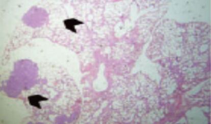 Metástasis de cáncer de mama en pulmón.