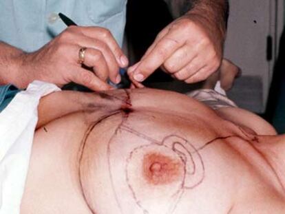 Preparación del pecho de una mujer para colocarle un implante mamario de silicona.