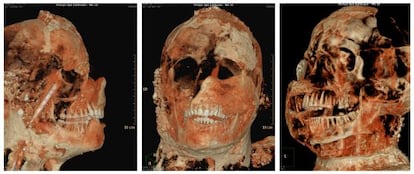 Una tomograf&iacute;a axial computarizada de una de las momias de Pompeya. 
