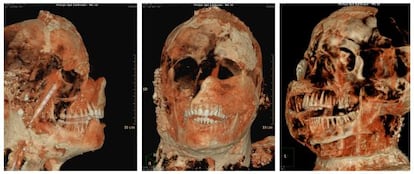 Una tomografía axial computarizada de una de las momias de Pompeya.