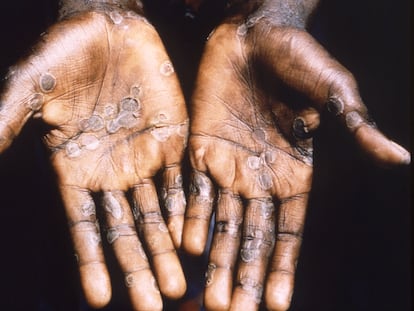 Lesiones en la piel provocadas por la viruela del mono, durante un estudio en la República Democrática del Congo entre 1996 y 1997.