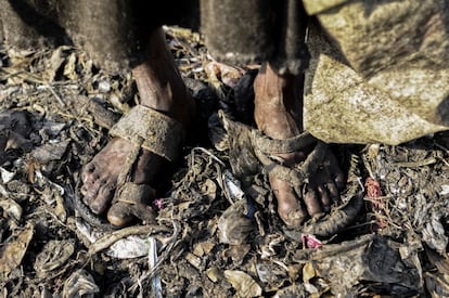 Muchos de los trabajadores del vertedero de Dacca van descalzos o en chancletas, algo que hace que la mayoría tenga úlceras en los pies.