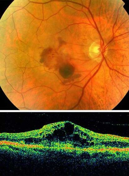 Fondo de ojo con degeneración macular (en el centro). Abajo perfil en el que las zonas oscuras representan fotorreceptores de la retina perdidos.