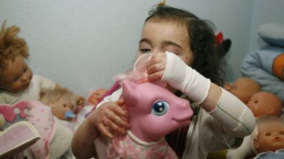 Lucía, una niña de tres años, afectada por la enfermedad conocida como piel de mariposa.