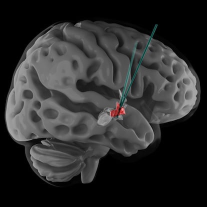 La ilustración muestra dónde se encuentra el hipotálamo y hasta donde tuvieron que llegar para colocar los electrodos para la estimulación cerebral profunda.