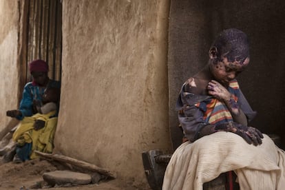 Fotografía ganadora del segundo premio individual en la categoría de problemas contemporáneos, tomada por la fotógrafa Adriane Ohanesian. La imagen muestra a Adam Abdel de 7 años gravemente quemado después de que una bomba lanzada por el gobierno sudanés cayera junto a la casa de su familia en Burgu (Sudán) el 27 de febrero de 2015.