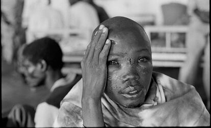Los estragos del genocidio en el rostro de un superviviente en un hospital de Kabgayi (Ruanda) en 1994.