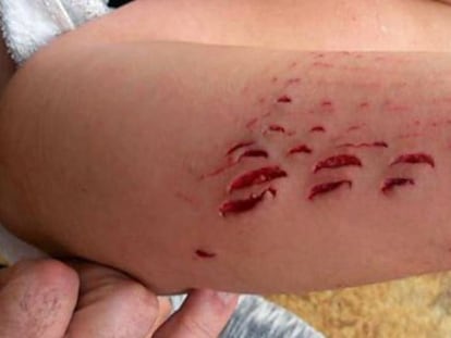 Image of the wounds left behind by the shark attack.