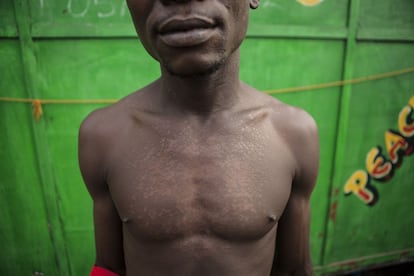 Mohamed, 31 años, muestra marcas de la piel que dice le han salido desde que vive en Old Fadama.