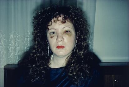 Nan, un mes después de haber sido agredida. 1984