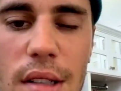 Justin Bieber parálisis