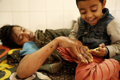 Abul Bajandar, conocido como 'hombre árbol', juega con su hija, Jannatul Ferdous Tahira, en una habitación de la unidad de quemados del hospital, en Daca, Bangladés.