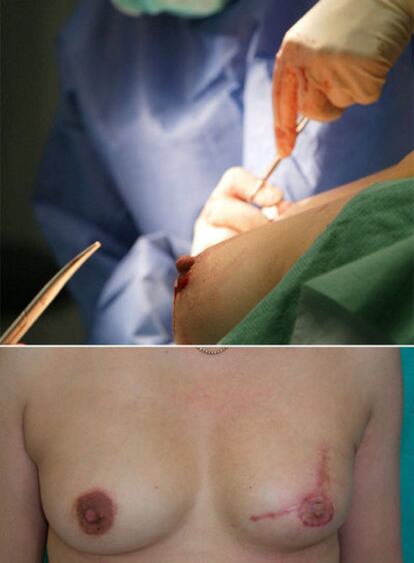 Arriba, un cirujano plástico reconstruye una mama. Abajo, imagen de una mujer tras la reconstrucción del pecho.