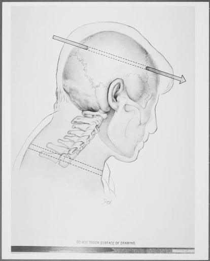 Reconstrucción realizada por dibujantes del FBI de las heridas del presidente de Estados Unidos, John F. Kennedy.