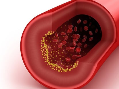 El colesterol malo obstruye los vasos sanguíneos.