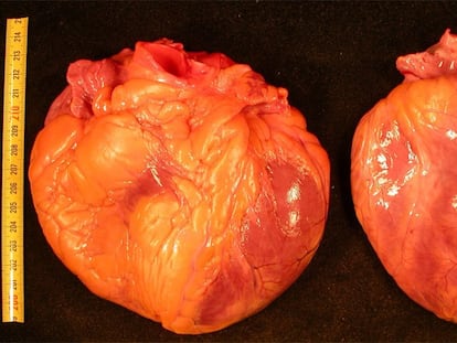 Corazón de un paciente fallecido por miocardiopatía dilatada (izquierda) y el de un sujeto sin esta enfermedad