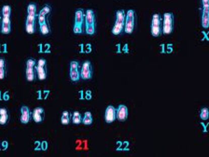 Cromosomas de un varón con síndrome de Down donde se ven las tres copias del 21.