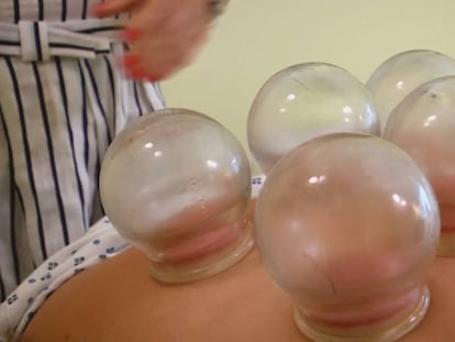 La polémica terapia detrás de los moratones de Michael Phelps: el ‘cupping’