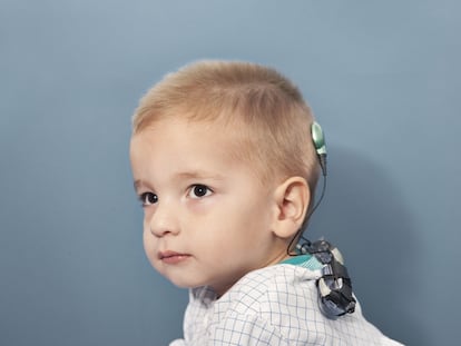 Leo, de dos años, con implantes cocleares en ambos oídos. 