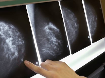 Una mamografía. En vídeo, detalles del descubrimiento.