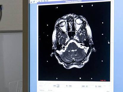 Un médico revisa una prueba diagnóstica del cerebro de un paciente. En vídeo, entrevista al neurocirujano Fran Martínez Ricarte.