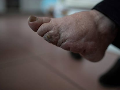 La señora Zhao, de 92 años, es una de las últimas chinas de pies vendados.