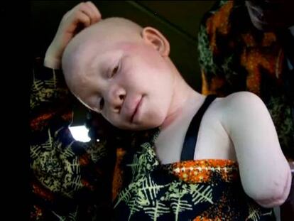 Una escuela que sirve de refugio para niños albinos en Tanzania