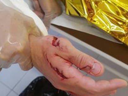 Heridas causadas por el mordisco.
