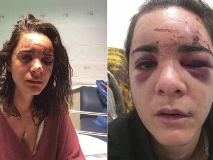 Andrea Sicignano, en dos fotografías publicadas por ella misma en su cuenta de Facebook tras la violación y agresión que sufrió en Aluche (Madrid). En vídeo, violan y golpean brutalmente a una joven estadounidense en Aluche, Madrid.