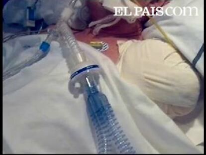 Un hombre de 62 años permanece ingresado en estado grave en la Unidad de Cuidados Intensivos (UCI) del Hospital de Requena (Valencia) afectado de la bacteria 'come carne' que le ha hecho perder el brazo izquierdo, según han informado fuentes sanitaria