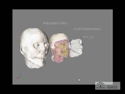 Reconstrucción computerizada del trasplante de estructura facial (I)