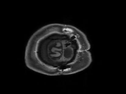 Imagen por resonancia magnética funcional en la que se muestra la actividad del medio cerebro que no fue extirpado