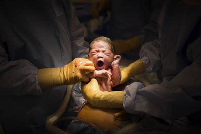 Un bebé nacido por cesárea.