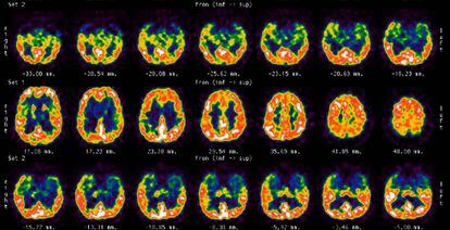 Imagen de la actividad cerebral. 