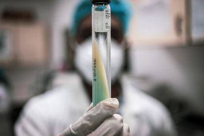 Muestra de tuberculosis que sujeta un técnico de laboratorio del CISM.  Pincha en el enlace para ver la fotogalería completa.